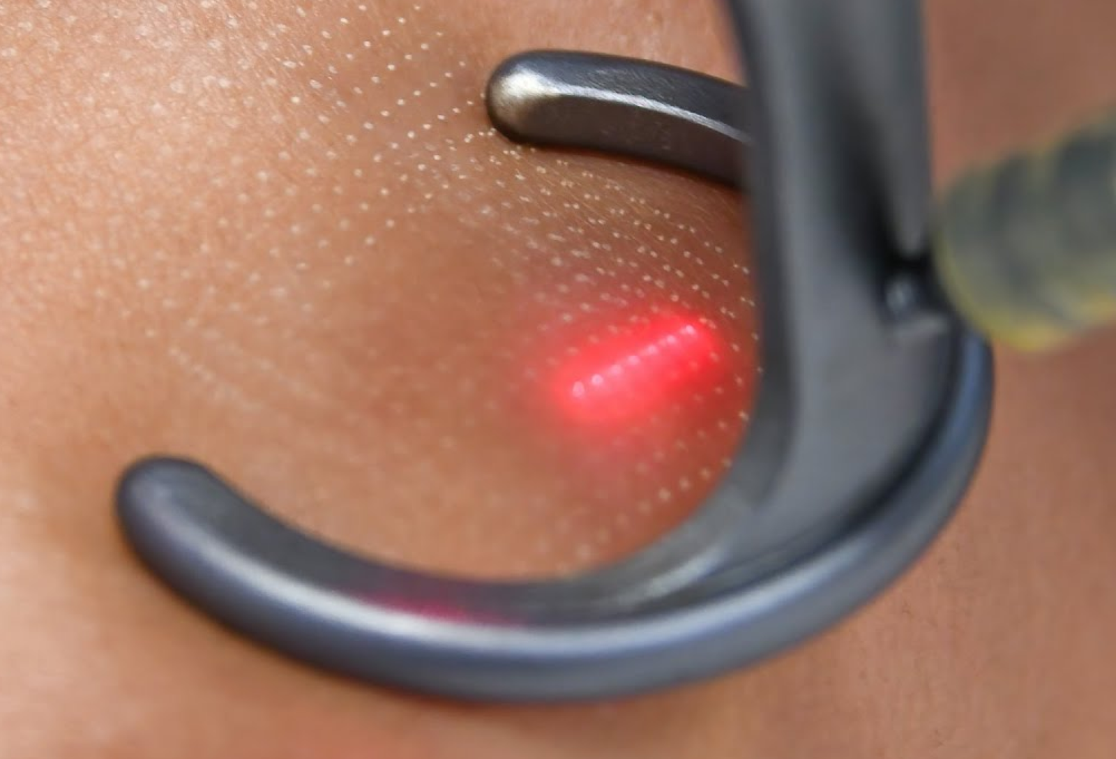 Fractional Co2 Laser